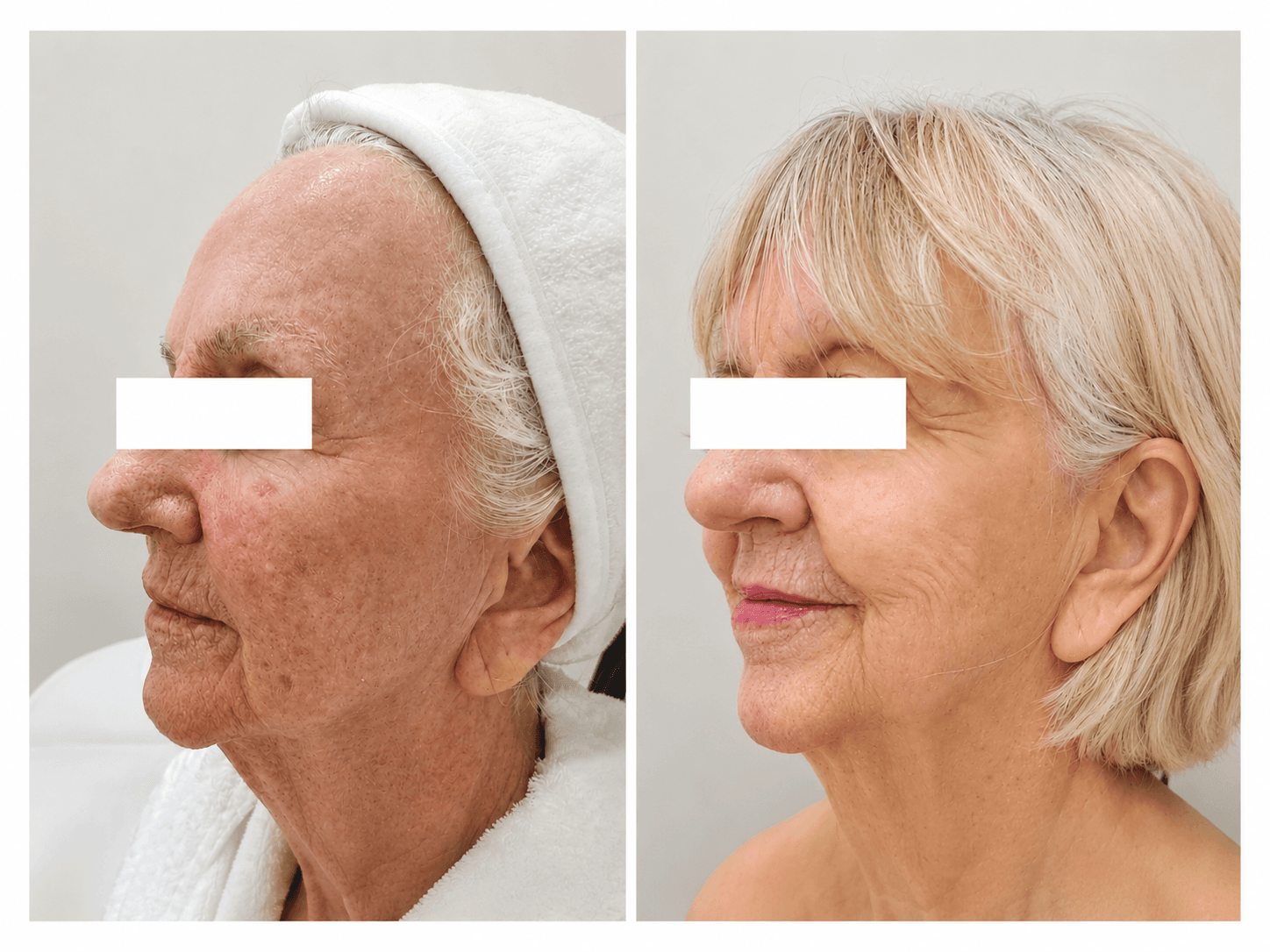 Skin Rejuvenation + Microneedling