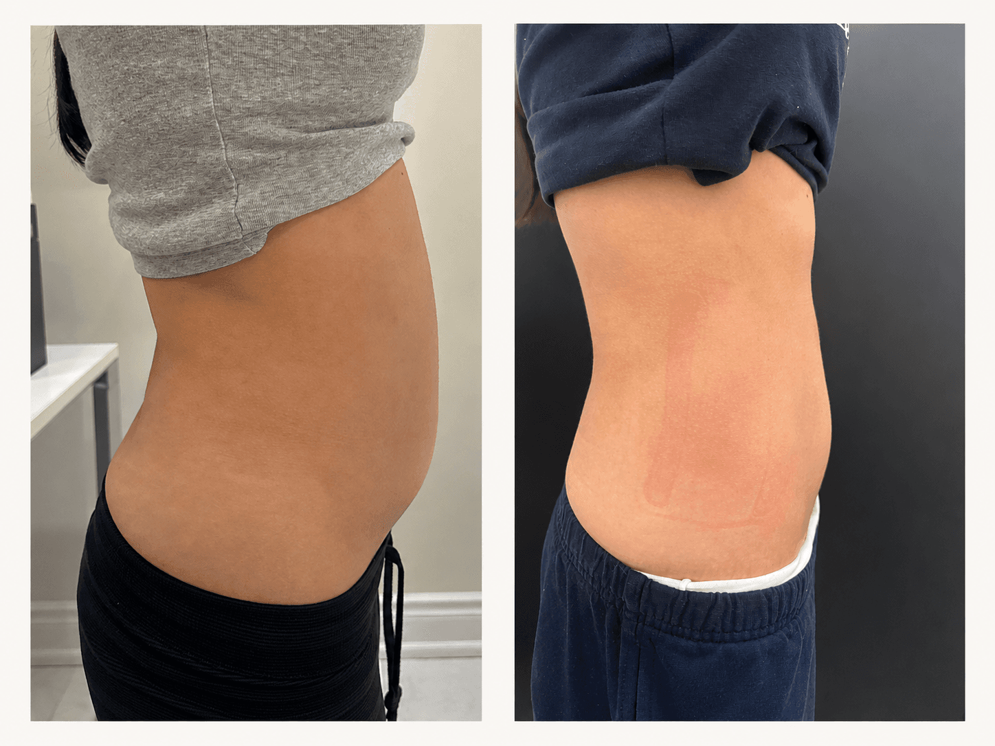 Body Contouring