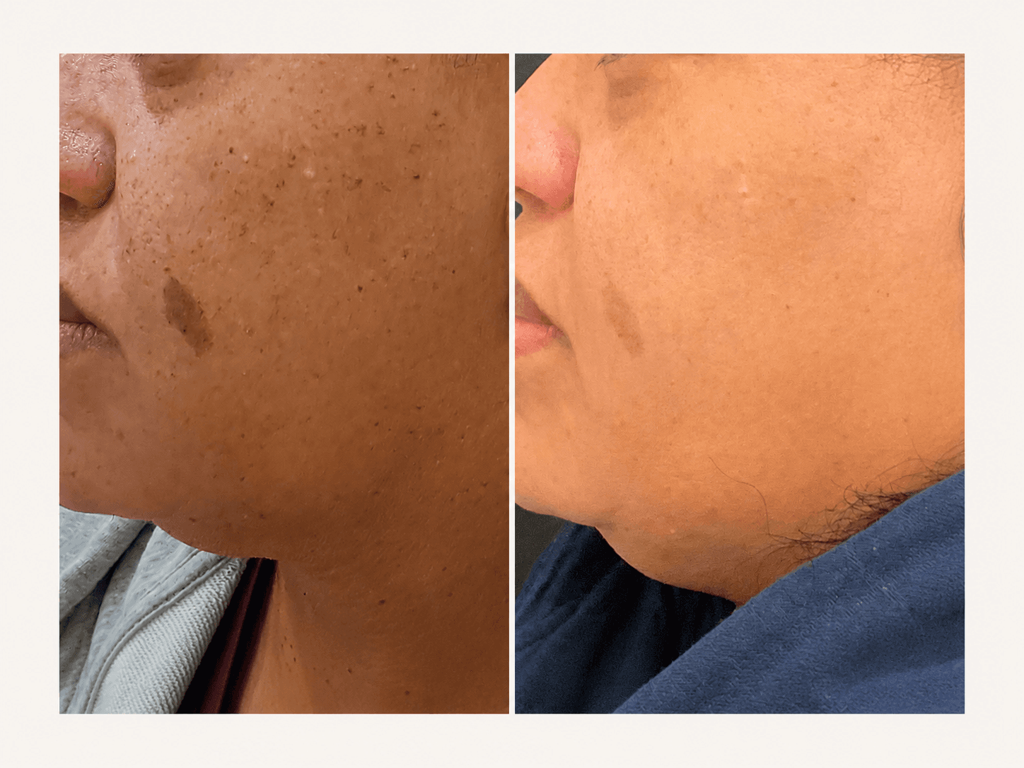 Laser Skin Rejuvenation + Microneedling