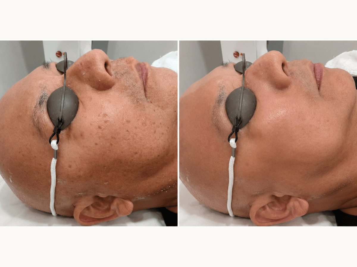 Skin Rejuvenation
