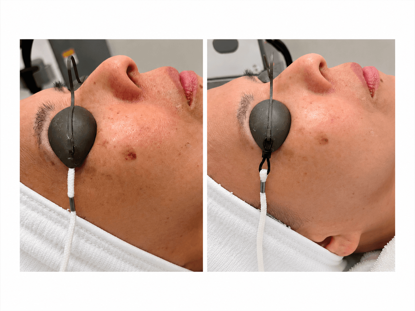 Skin Rejuvenation